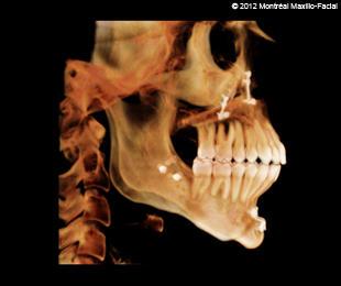 Marie-Hélène Cyr - Scan 3D (profil droit) après des traitements d'orthodontie et des chirurgies orthognatiques (13 février 2012)